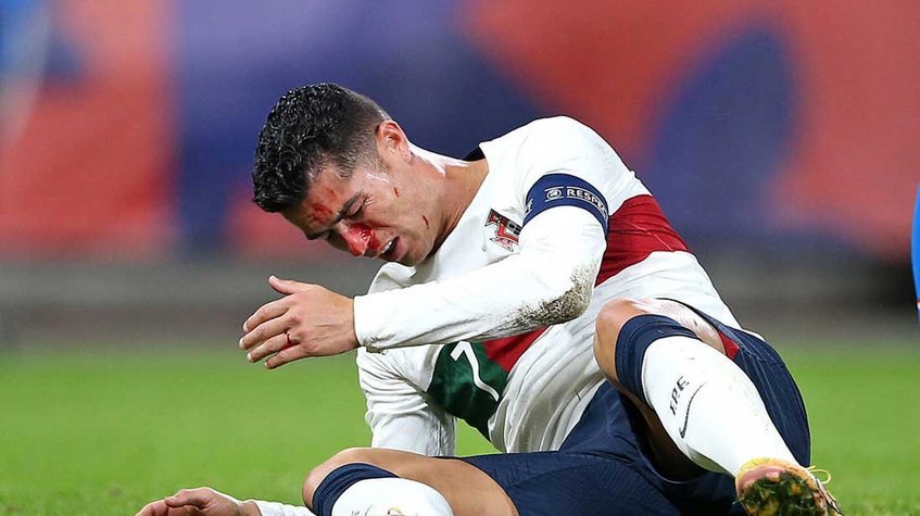 Cristiano Ronaldo terminó con la nariz rota luego de un partido