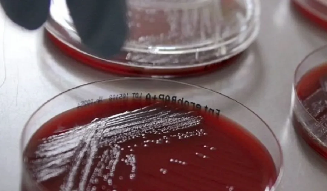 Cinco muertes por bacteria «come carne» este año en Florida