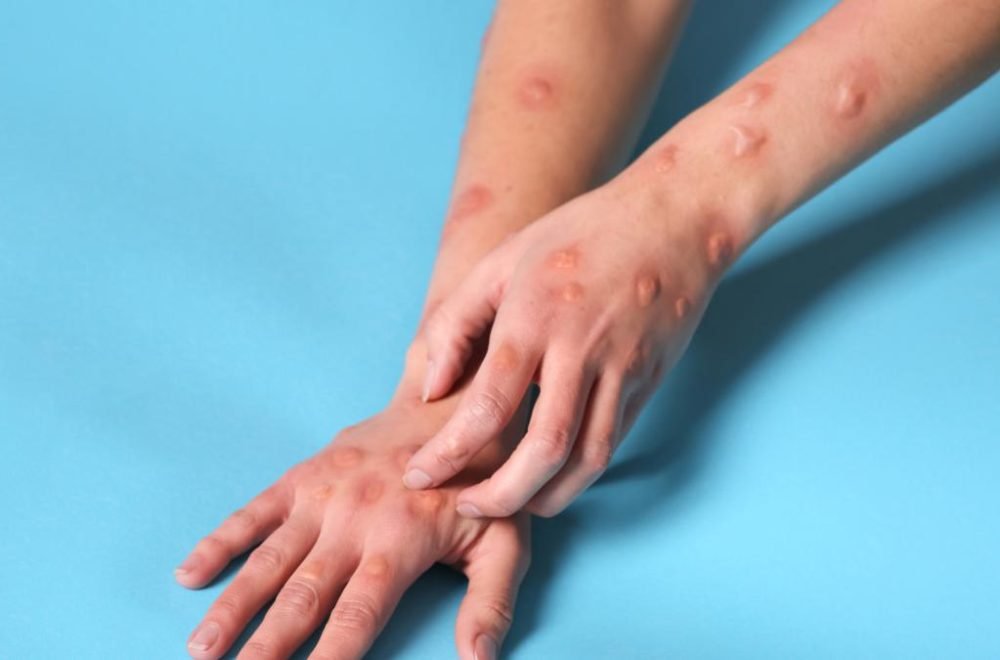 Florida en alerta por casos de Mpox en medio de nueva variante